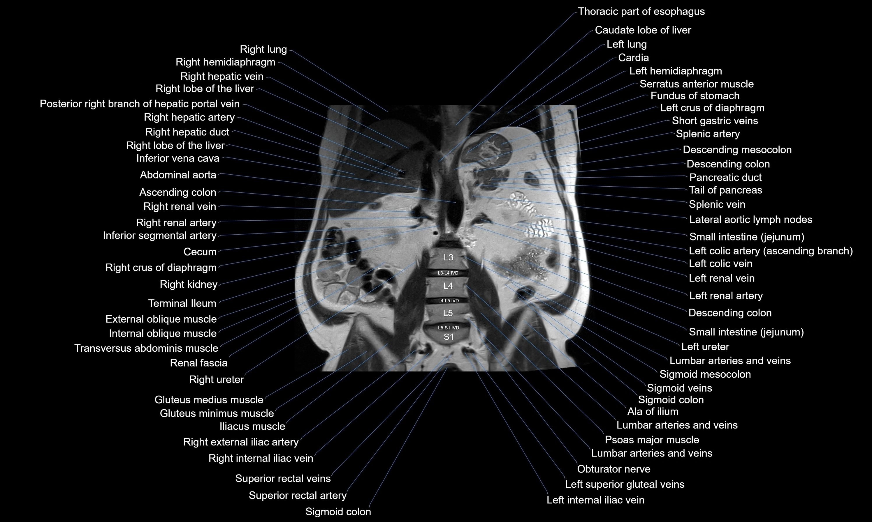 MRI Abdomen axial cross sectional anatomy radiology  image-img-00001-00034.webp